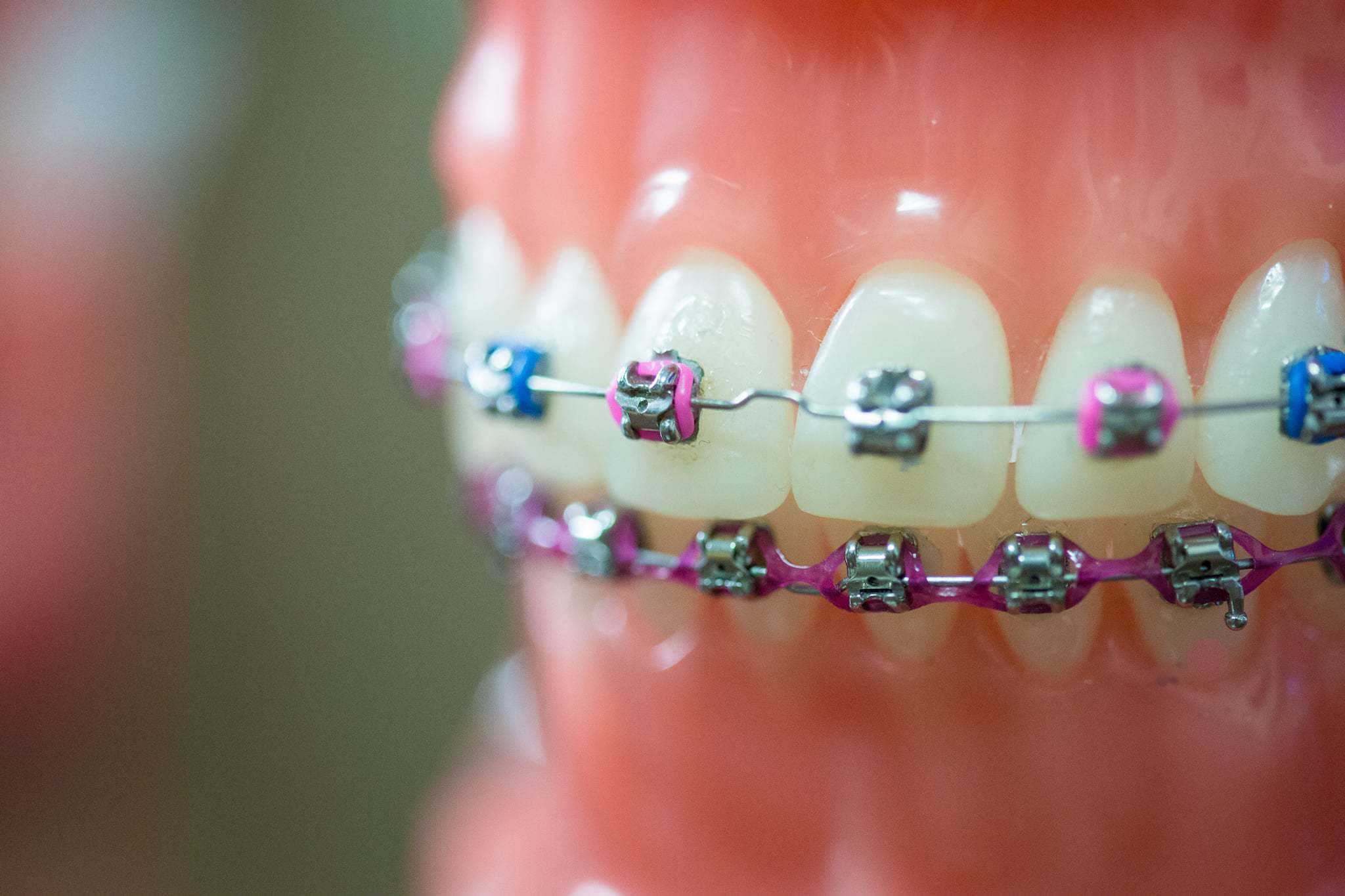 Fergus Orthodontics Jonesboro Arkansas General Shots 114 - 12 Things to Know About Braces or Invisalign