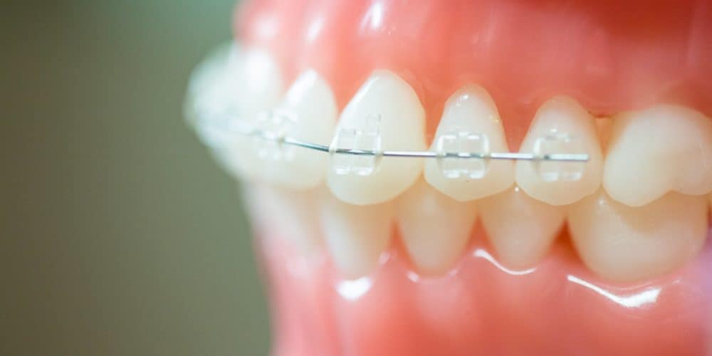 Clear Braces Jonesboro, AR Family Orthodontist