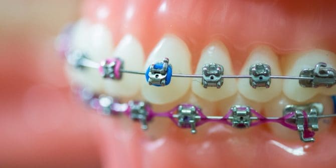 Clear Braces: What Are They? - Oak Tree Dental Ashburn Virginia