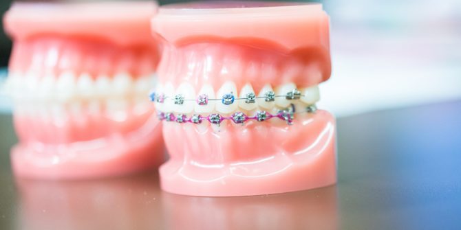 Fergus Orthodontics Jonesboro Arkansas General Shots 127 670x335 - Treatment Options