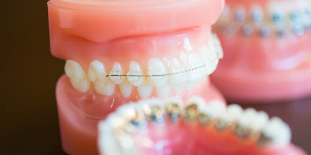 Clear Braces Jonesboro, AR Family Orthodontist