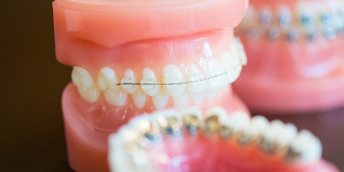 Fergus Orthodontics Jonesboro Arkansas General Shots 160 670x335 - Clear Braces