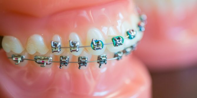 Fergus Orthodontics Jonesboro Arkansas General Shots 164 670x335 - Braces for Adults, Teens and the Entire Family in Jonesboro Arkansas