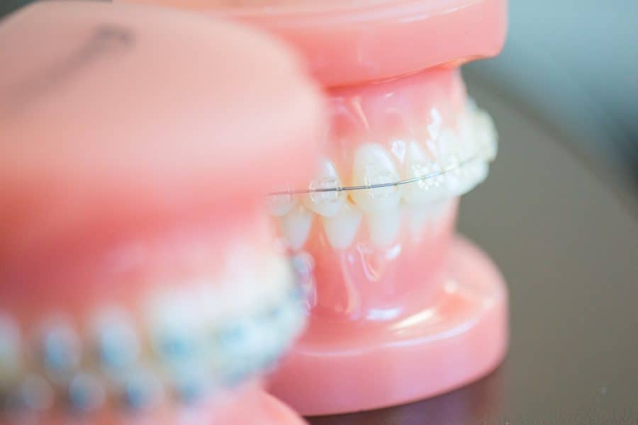 Clear Braces Jonesboro, AR Family Orthodontist