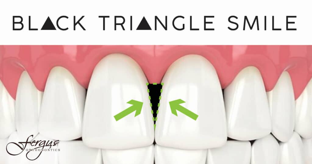 Why Do I Have Black Triangles in My Teeth Jonesboro, AR