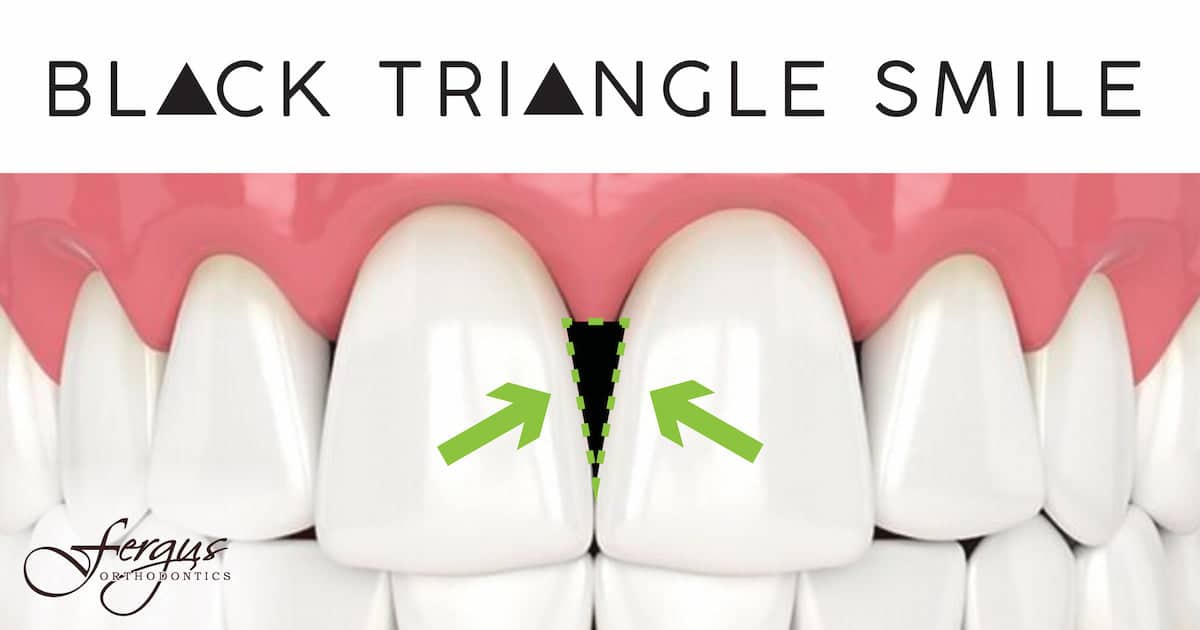 Fergus black triangle 1200x630 - Black Triangles in Teeth: What They Say About Your Dental Health